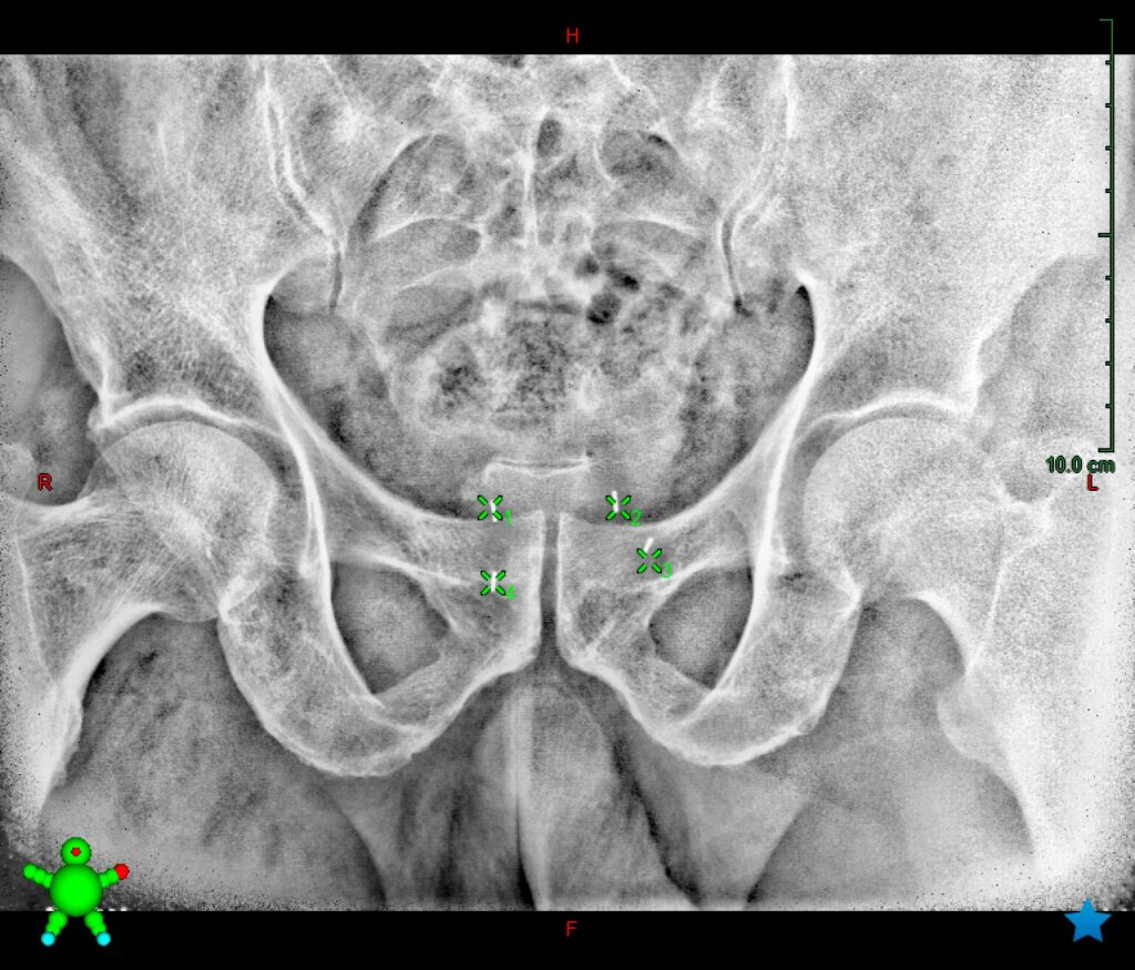 Fiducial marker check